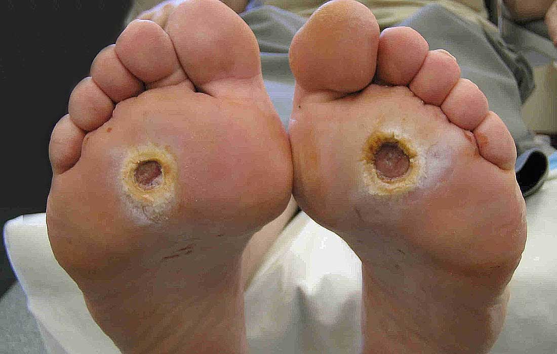Diabetic foot ulcer - Wikipedia