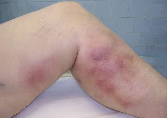 superficial thrombophlebitis pictures