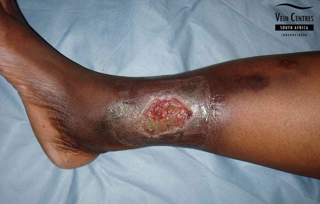 Varicose Veins Ulcer