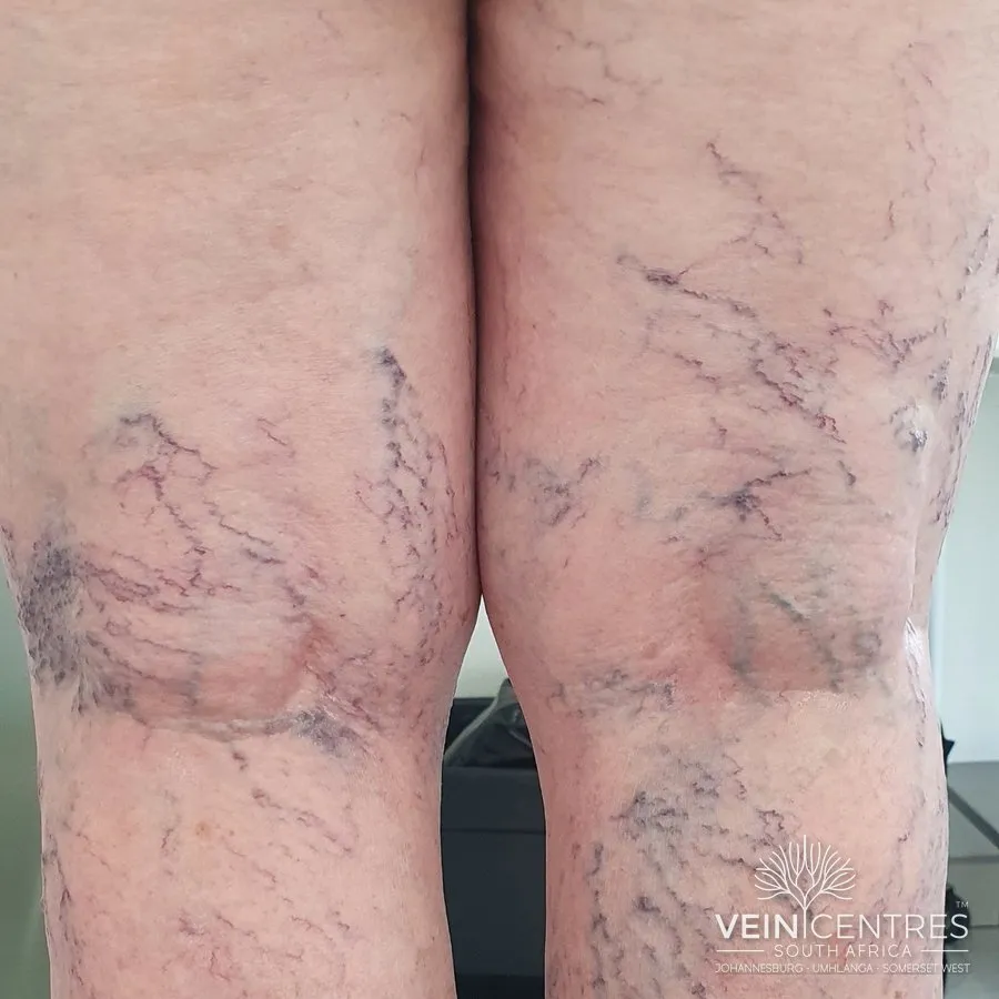 C1: Telangiectasias or reticular veins