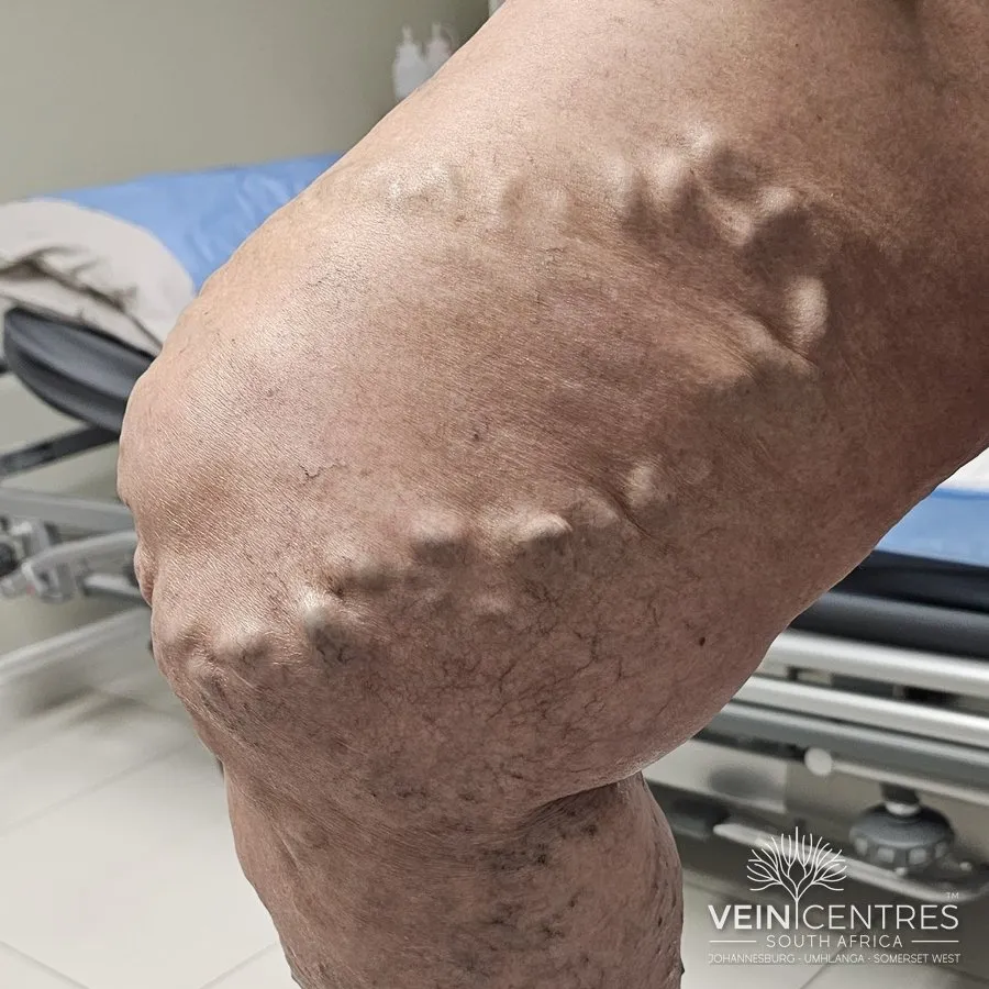 C2: Varicose veins: 3 mm or more in diameter, standing