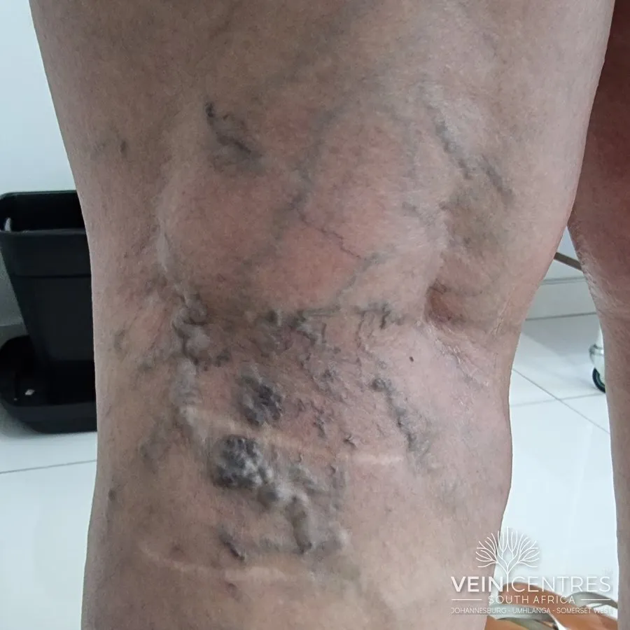 C2r: Recurrent varicose veins, after previous intervention