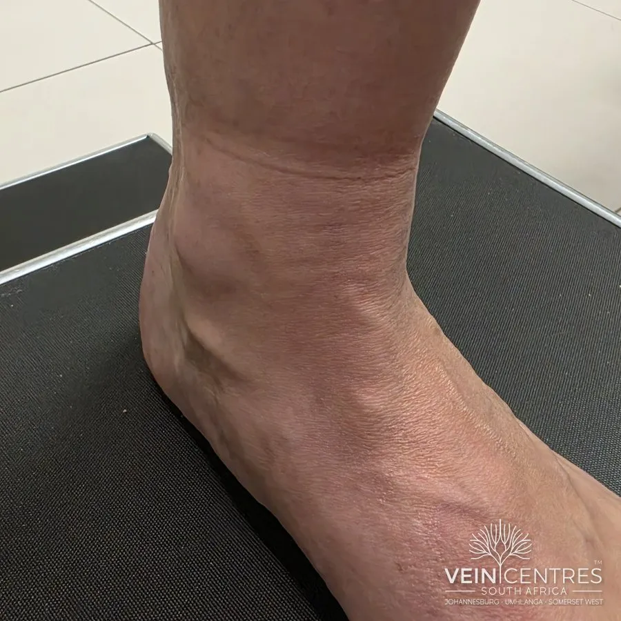 C3: Oedema of venous origin