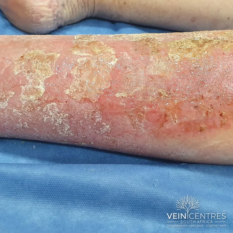 C4a: Pigmentation or eczema