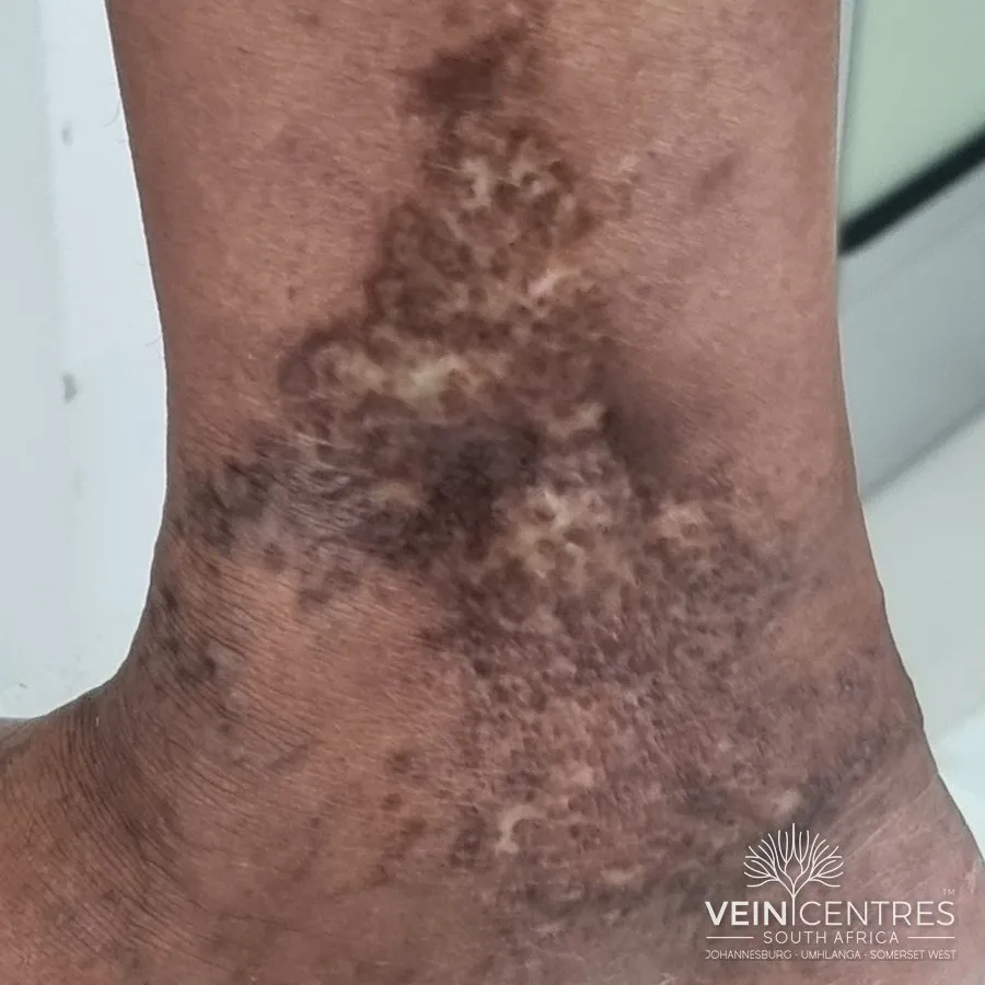 C4b: Lipodermatosclerosis or atrophie blanche