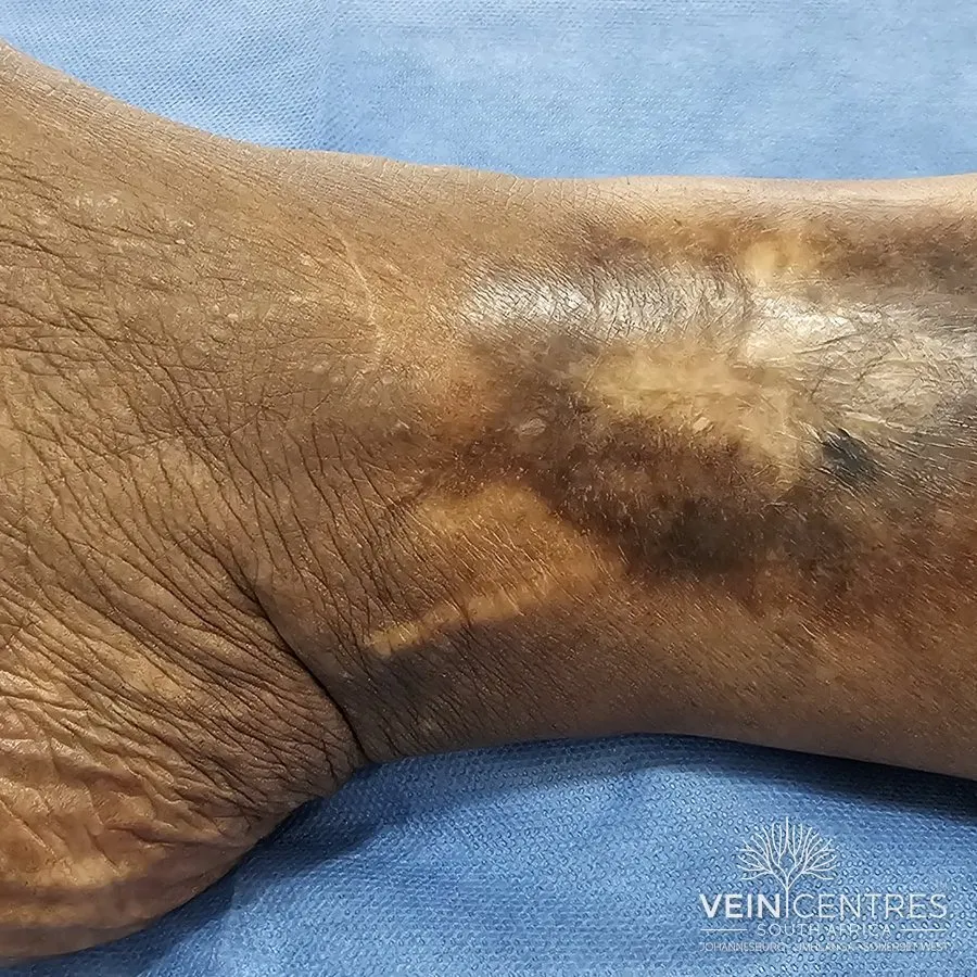 C5: Healed venous ulcer