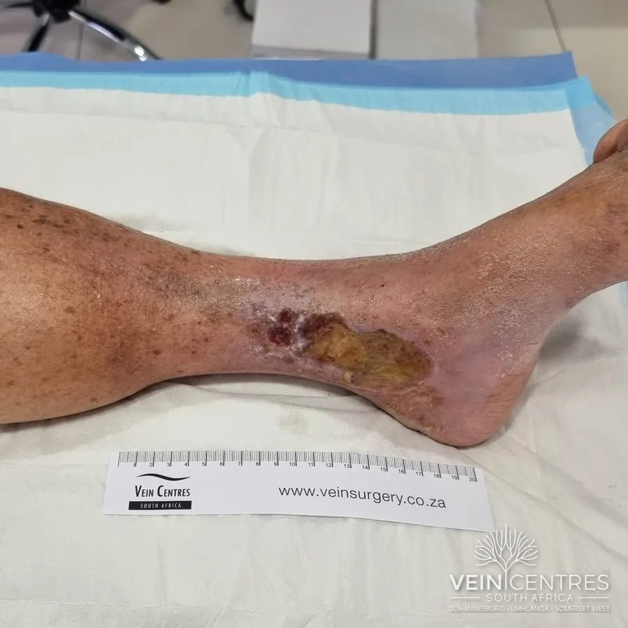 C6: Active venous ulcer