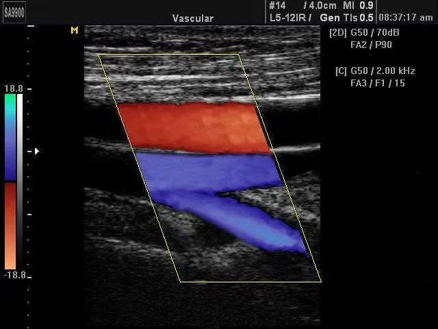 Colour duplex ultrasound image showing blood flow in a leg vein
