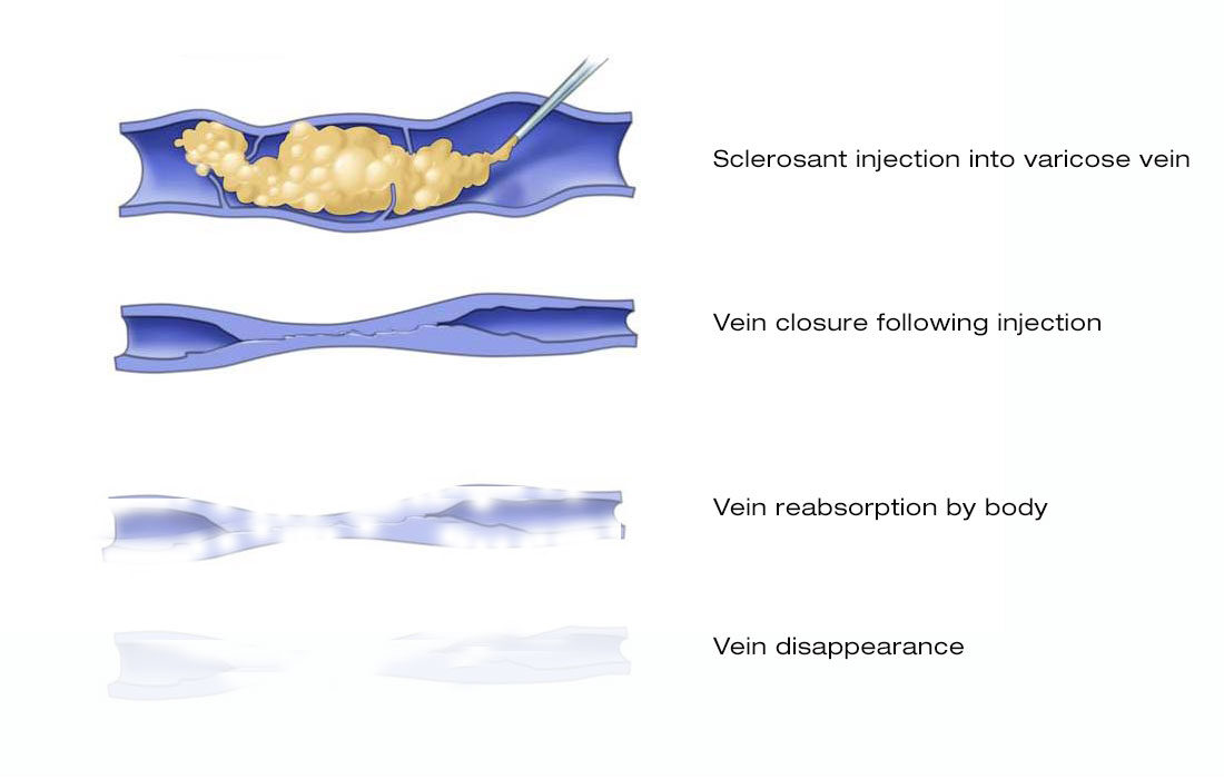 Ultrasound guided foam sclerotherapy injection