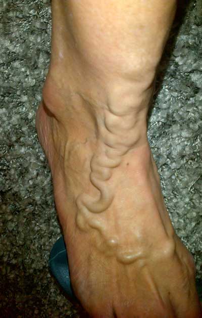 Varicose veins right foot dorsum