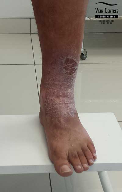 Venous eczema left ankle before treatment