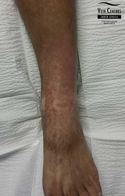 Venous eczema left ankle after treatment