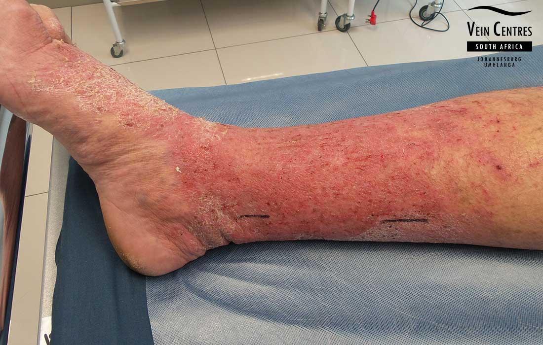 Venous eczema right leg before treatment