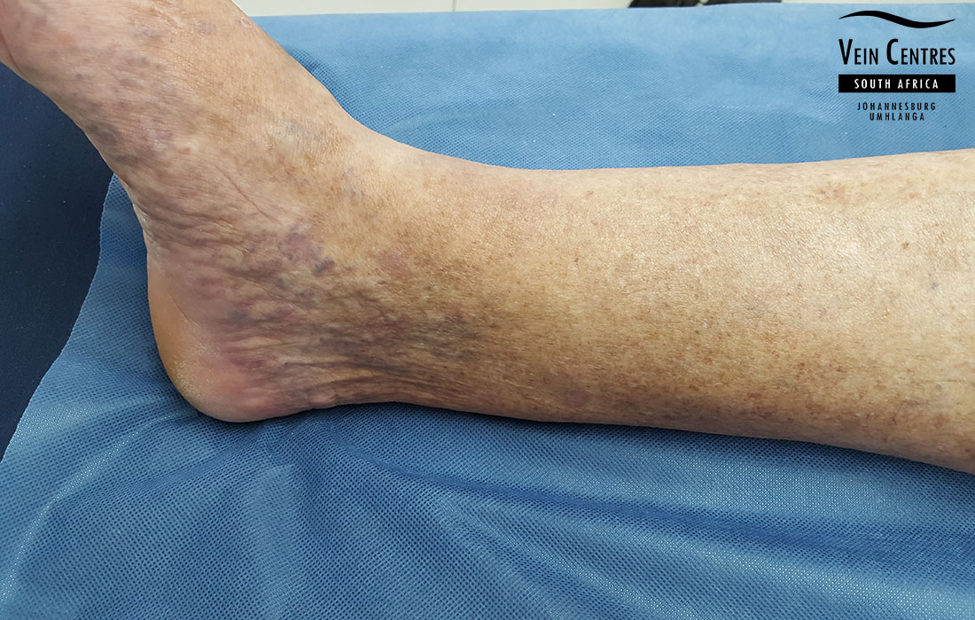 Venous eczema right leg after treatment
