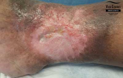Venous Ulcer after treatment