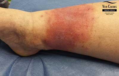 Venous eczema right leg before treatment