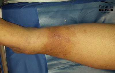 Venous eczema after treatment