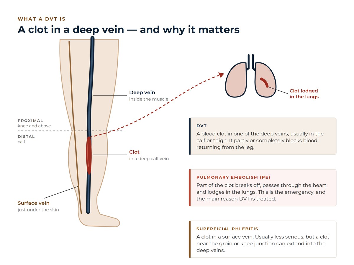 Diagram of a leg showing a blood clot in a deep calf vein, the difference between proximal and distal DVT, and part of the clot travelling to the lungs as a pulmonary embolism.