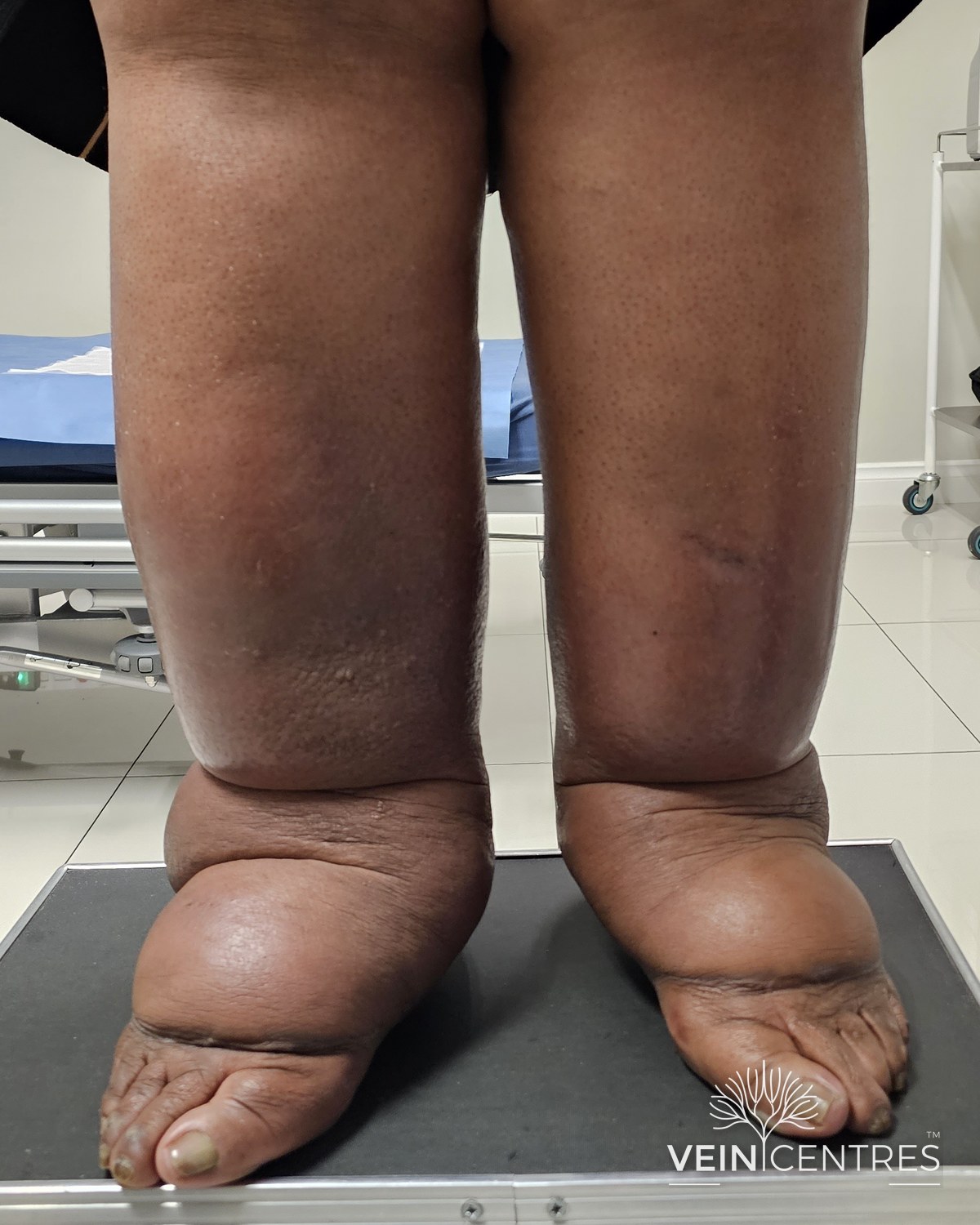 Bilateral leg swelling extending into the feet and toes