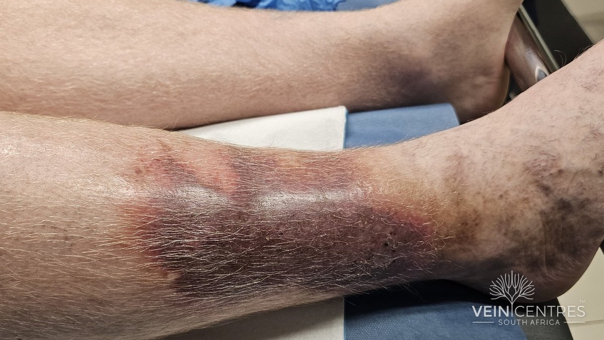 A well-demarcated red-violaceous plaque above the ankle with scaling and pigmentation extending onto the foot, typical of lipodermatosclerosis mistaken for cellulitis.