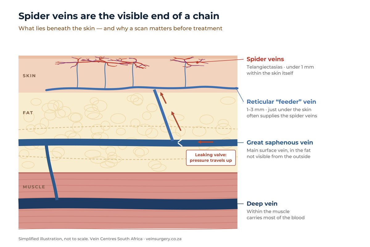 Cross-section of the leg showing spider veins in the skin, a reticular feeder vein just beneath them, the great saphenous vein in the fat layer and a deep vein within the muscle, with a leaking saphenous vein transmitting pressure up to the spider veins.