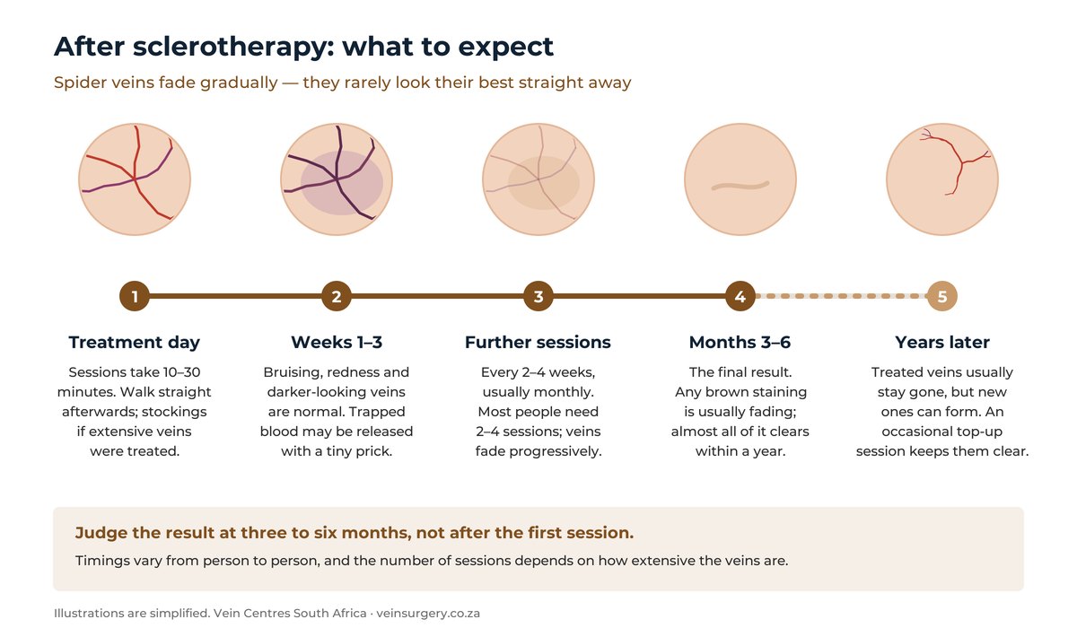 Timeline after sclerotherapy for spider veins: bruising and darker veins in the first weeks, gradual fading with further sessions two to four weeks apart, the final result at three to six months, and new veins possibly developing over the following years.
