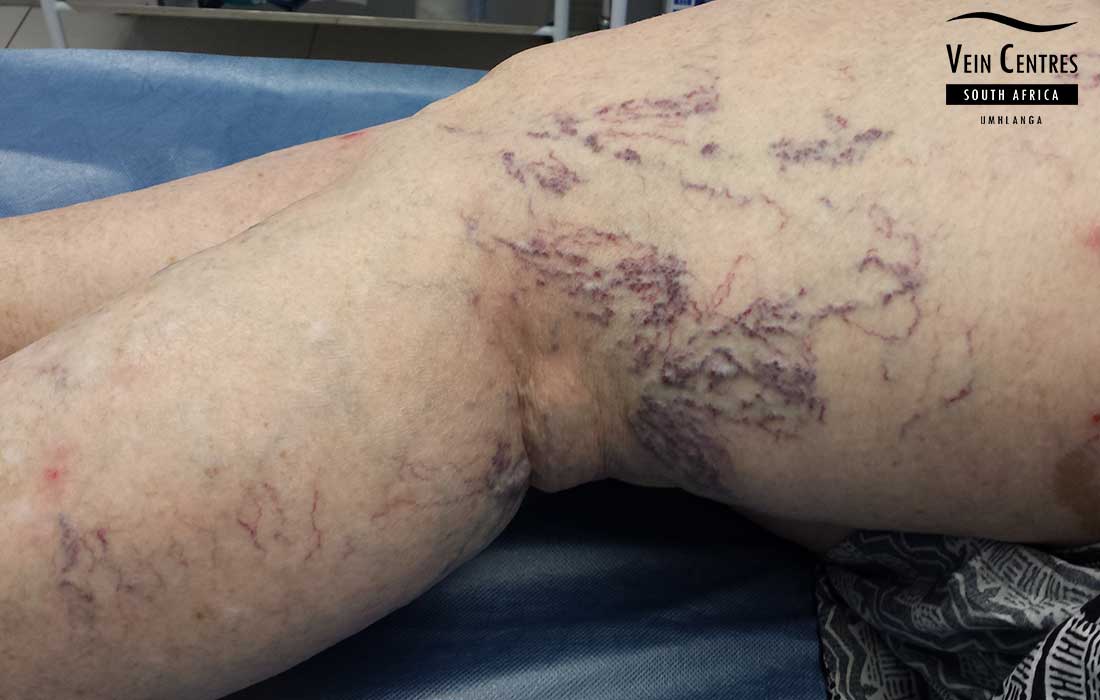 Extensive leg spider veins