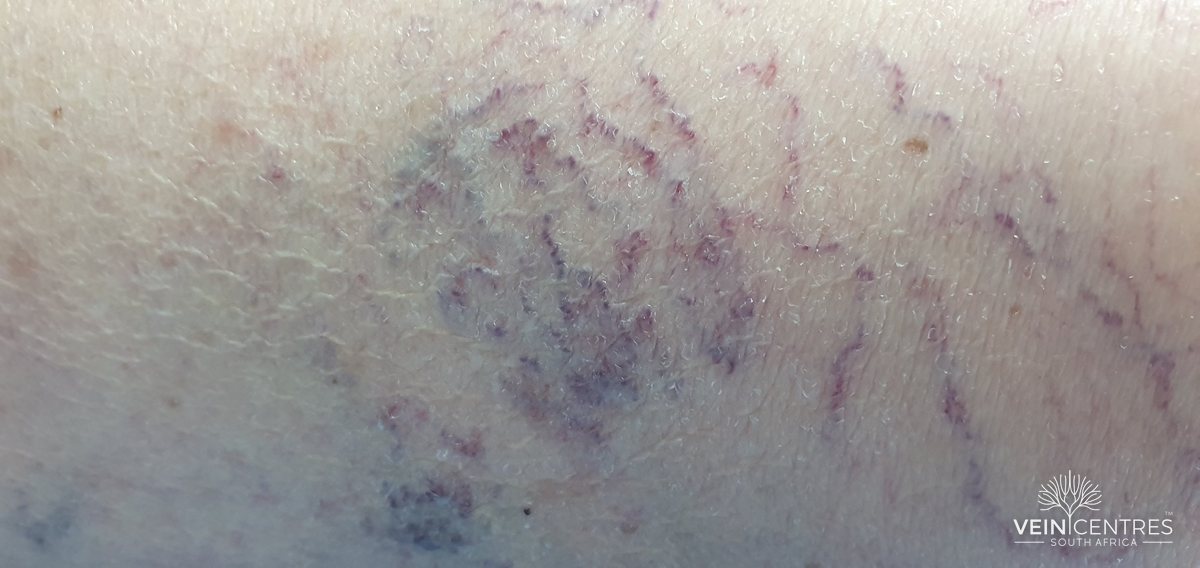 Close-up photograph of spider veins on a leg: fine red and purple thread-like veins in the skin, with bluish patches of slightly deeper veins beneath them.
